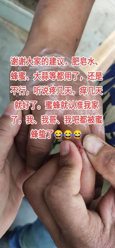 被蜜蜂蛰了怎么办？