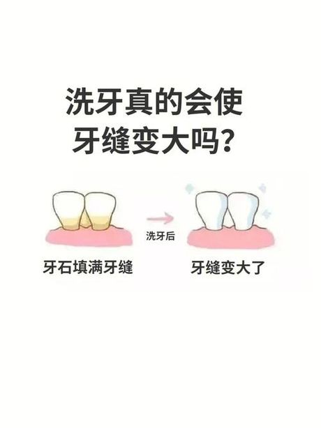 牙缝变大：原因及预防