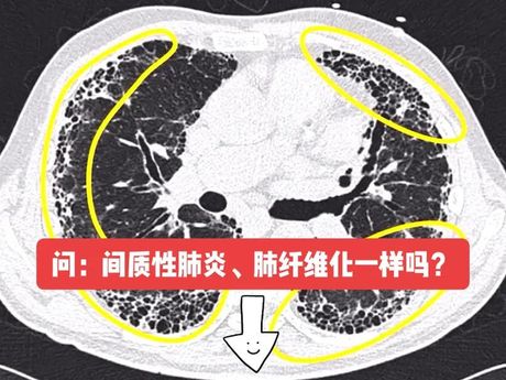 肺间质性改变：了解这一重要肺部现象