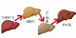 肝硬化能活多久：了解疾病与预期寿命的关系